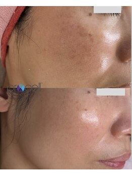 ジョアン(Johan)/プロセルで再生ケア◆