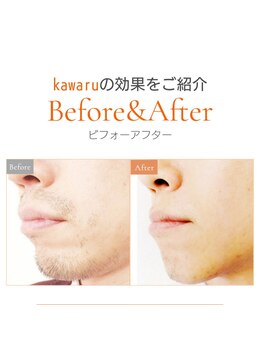 カワル(kawaru)の写真/【長久手】1万人実績の代表が贈る一生モノの清潔感◎朝の支度が劇的に楽に!毎日の髭剃り+青ヒゲ解決へ♪