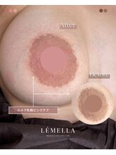 エルビービュティーサロン(LB BEAUTY SALON)/【ルメラ乳輪】実績数関西1★