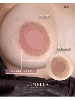 エルビービュティーサロン(LB BEAUTY SALON)/【ルメラ乳輪】実績数関西1★