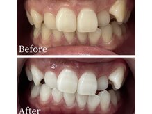 ホワイト 福岡天神店(WHITE)/ホワイトニングビフォーアフター