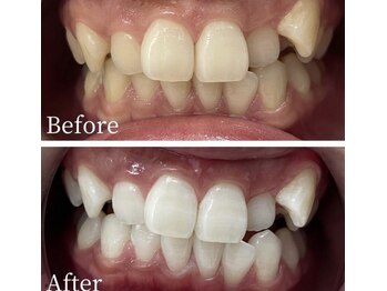 ホワイト 福岡天神店(WHITE)/ホワイトニングビフォーアフター