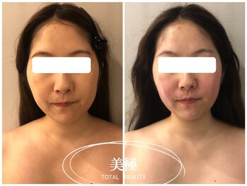 美極 銀座店/銀座/小顔コルギ/小顔矯正