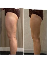 OBS/ガチガチ凸凹セルの老廃物流し