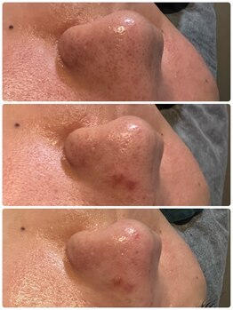 ベルーチェ(Beluce)/30代男性/毛穴の目立たない肌へ