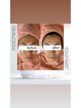 カフネ(CAFUNE.)/美白メニュー