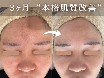 ブルーエム 大森(Blue-M)/肌質改善、3ヶ月の経過