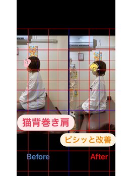 ヒデ整体院(Hide整体院)/猫背矯正骨盤矯正B/A肩こり腰痛