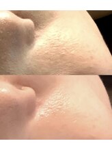 エミルカ 仙台(EMILUCA)/陶肌トリートメント