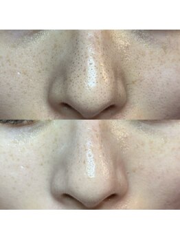 エミュ(emu)/毛穴×ハーブですっぴん美人