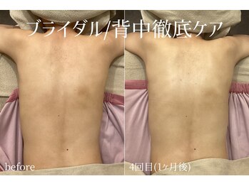 ハティア(hattia)/背中ニキビ・くすみ解消♪