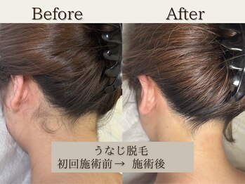 インベスト(INVEST)/うなじ脱毛