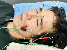 とだ鍼灸院/【顔の引き締め◎】美容鍼/電気
