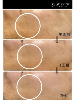 ミニン(minin)/シミケア