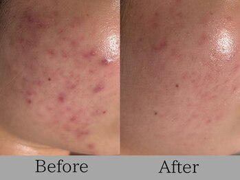 ルミライズ(lumirise)/〈9回目での効果〉