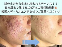 シンディー(CINDY)の雰囲気(研磨剤不使用で肌に優しく奥まで届ける韓国最新ハーブピーリング)