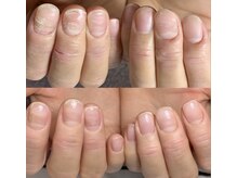 ロイヤル ネイルサロン(Royal nail Saloon)/トラブル爪を無理なく解消