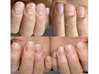 ロイヤル ネイルサロン(Royal nail Saloon)/トラブル爪を無理なく解消