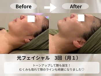 モア 星ヶ丘店(MORE)/光フェイシャル