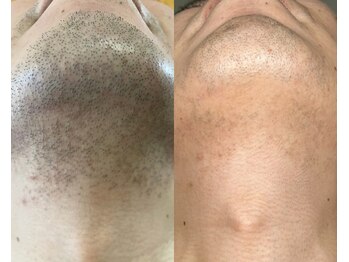 NTエステティック 西条店の写真/初めてでも安心！都度払い＆完全個室のメンズ脱毛で、理想のツル肌を叶えます◎