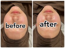 ブリリアント(Brilliant)/プルプル美白