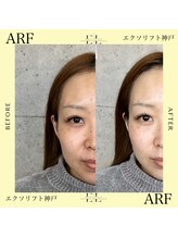 アーフ(ARF)/エクソリフト
