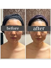 小顔アンドエイジングケア専門店 ビゼ(美sser)/美sser小顔コルギ