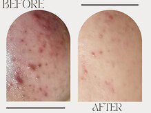 ニコリ(NICOLI)/ダメージ跡にアプローチ！