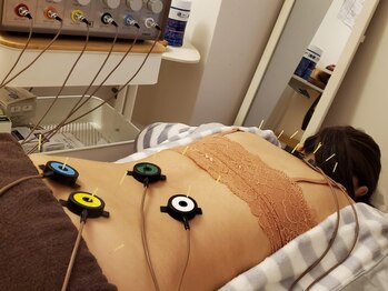 はり灸心音の写真/【つらい腰痛を根本改善】マッサージでは届きにくい深層部へ直接アプローチ♪全身鍼灸 初回￥5390