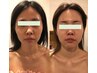 OPEN記念♪30代におすすめ！開き毛穴×たるみ改善☆高周波☆（顔のみ）1０0分