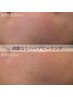 【繰り返しニキビ/毛穴凸凹ケア】ハーブピーリング+再生因子付き￥14,800