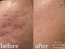 ボニータアンジュ 恵比寿(Bonita Ange)/恵比寿ハーブピーリング｜症例