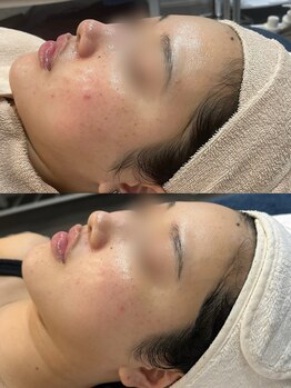 パリスヒロトン(PARIS HIROTON)/オプティル6回/タイトニング