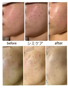 ムク(MUKU 無垢)/シミケア