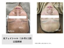 イル 名取店(iru)/光フェイシャル