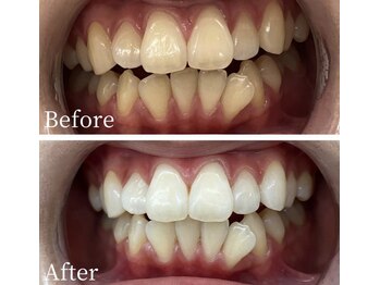 ホワイト 福岡天神店(WHITE)/ホワイトニングビフォーアフター