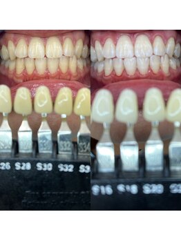 トウキョウスワーズ 池袋店(TOKYO SWRS)/#ホワイトニング #池袋 #渋谷