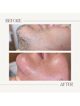 スプランドゥール(Splendeur)/メンズ【ひげ】WAX+光