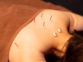 桜の眠り/お悩み合わせた鍼灸メニュー