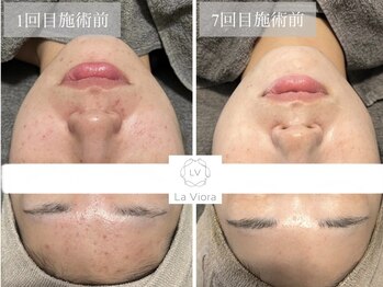 ラヴィオーラ 神戸兵庫店(La Viora)/ダイヤモンドハーブピーリング