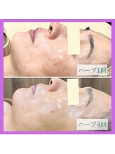 アヴァンス(AVANCE)/ハーブと光フォトでくすみ解消♪