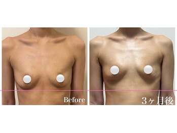 ドリームバスト 南森町(Dream Bust)/3ヶ月でバストアップ/バストケア