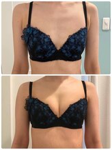 美人バスト 本厚木店/【バストアップ☆育乳】◇症例