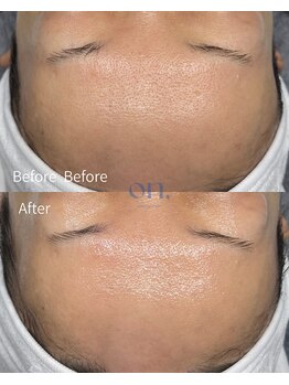 オン(on.)/メソプロ施術直後 Before /After