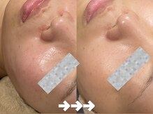 フローラスキン 恵比寿Amour店(florasKIN)/肌質改善(水光注入)