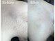 美意識の写真/夏に向けて全身美肌脱毛！安心施術で理想のつる肌へ導きます♪