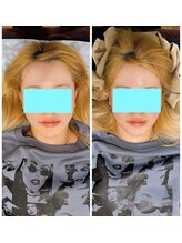 イズム まつもと店(izm)/小顔モニター様