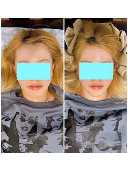 イズム まつもと店(izm)/小顔モニター様