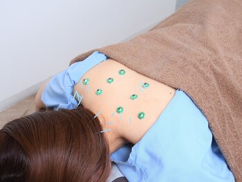 ウル鍼灸整骨院/鍼灸(首肩)施術♪