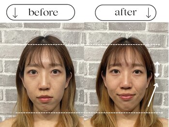 ビースタイル(B-style)/【電気美容鍼】ビフォーアフター